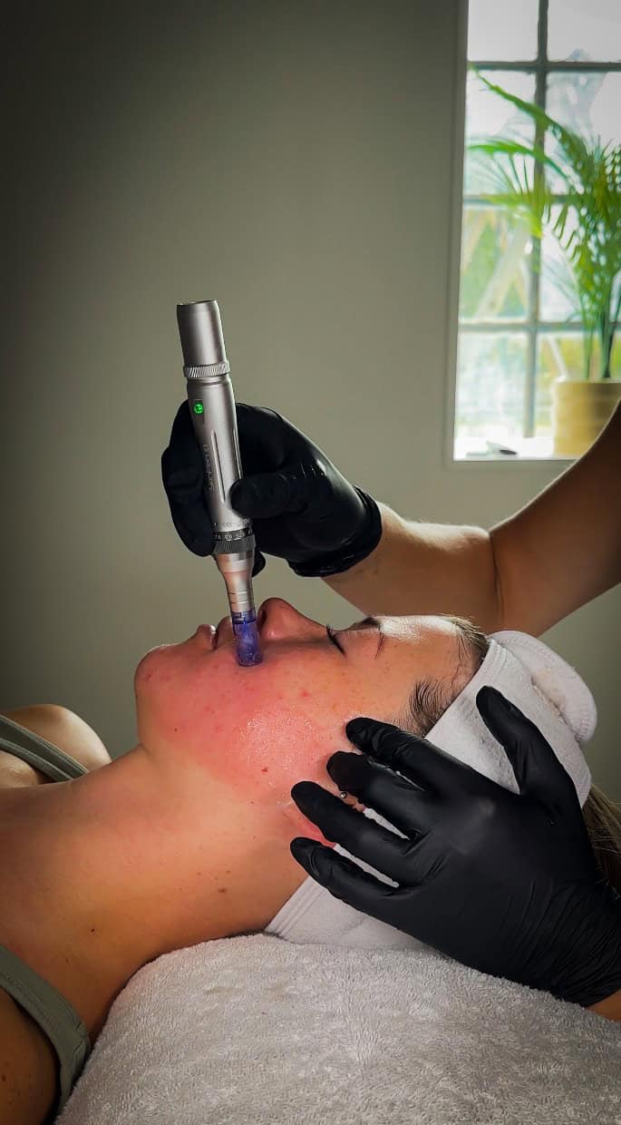 Microneedling i Viby Sjælland - SkinPen 